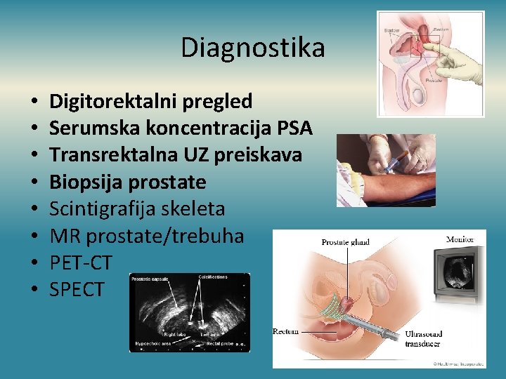 Diagnostika • • Digitorektalni pregled Serumska koncentracija PSA Transrektalna UZ preiskava Biopsija prostate Scintigrafija