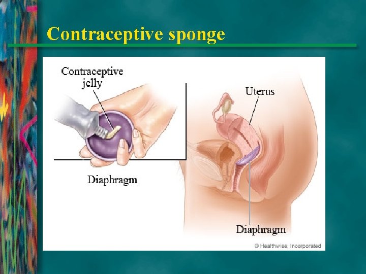 Contraceptive sponge 