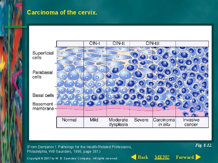 Carcinoma of the cervix. Fig. 8 -12. (From Damjanov I: Pathology for the Health-Related