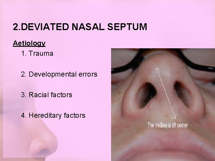 2. DEVIATED NASAL SEPTUM Aetiology 1. Trauma 2. Developmental errors 3. Racial factors 4.