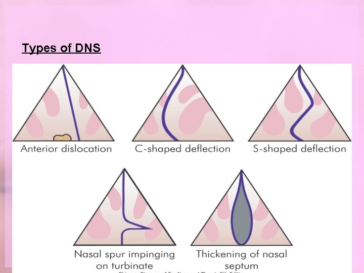 Types of DNS 