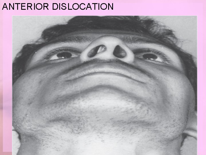 ANTERIOR DISLOCATION 