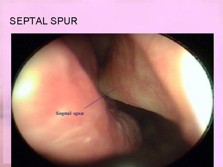 SEPTAL SPUR 