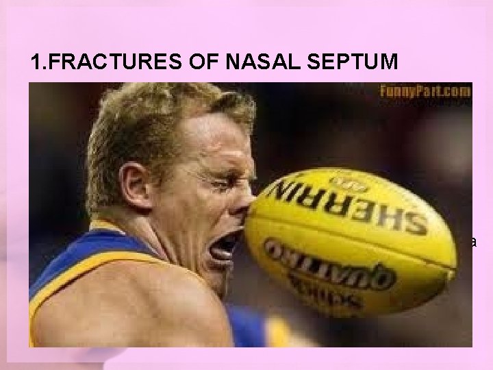 1. FRACTURES OF NASAL SEPTUM Aetiopathogenesis • Trauma • Fate of septum - buckling