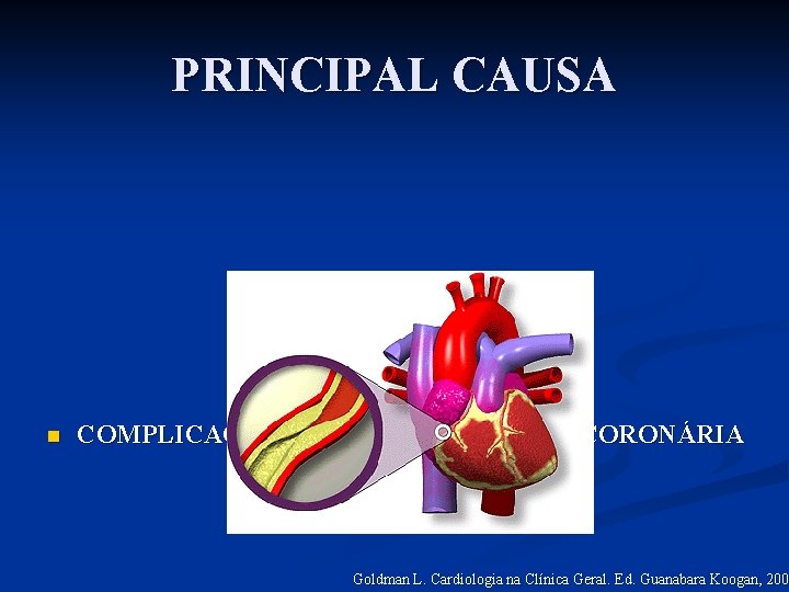PRINCIPAL CAUSA n COMPLICAÇÃO DA ATEROSCLEROSE CORONÁRIA Goldman L. Cardiologia na Clínica Geral. Ed.