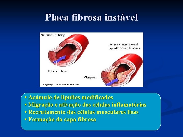 Placa fibrosa instável • Acúmulo de lipídios modificados • Migração e ativação das células