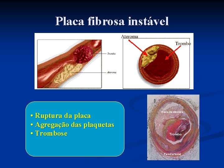 Placa fibrosa instável • Ruptura da placa • Agregação das plaquetas • Trombose 