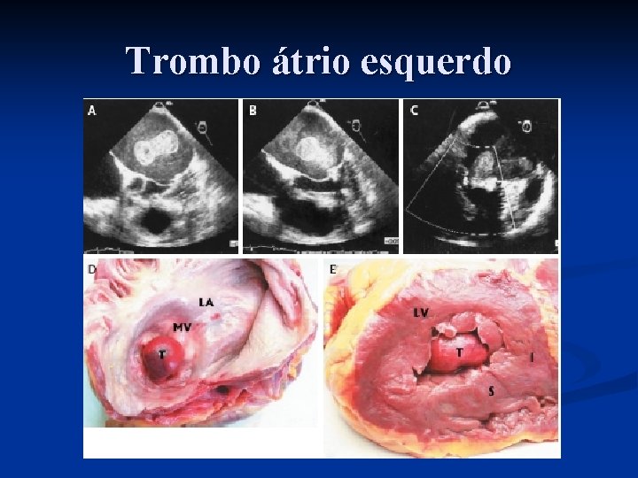 Trombo átrio esquerdo 