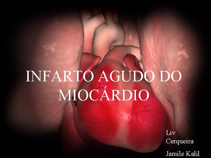 INFARTO AGUDO DO MIOCÁRDIO Liv Cerqueira Jamile Kalil 
