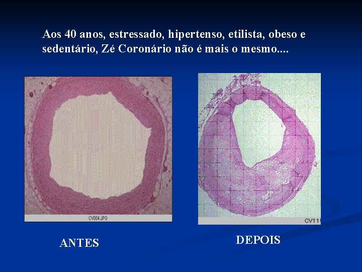 Aos 40 anos, estressado, hipertenso, etilista, obeso e sedentário, Zé Coronário não é mais