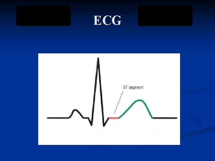 ECG 