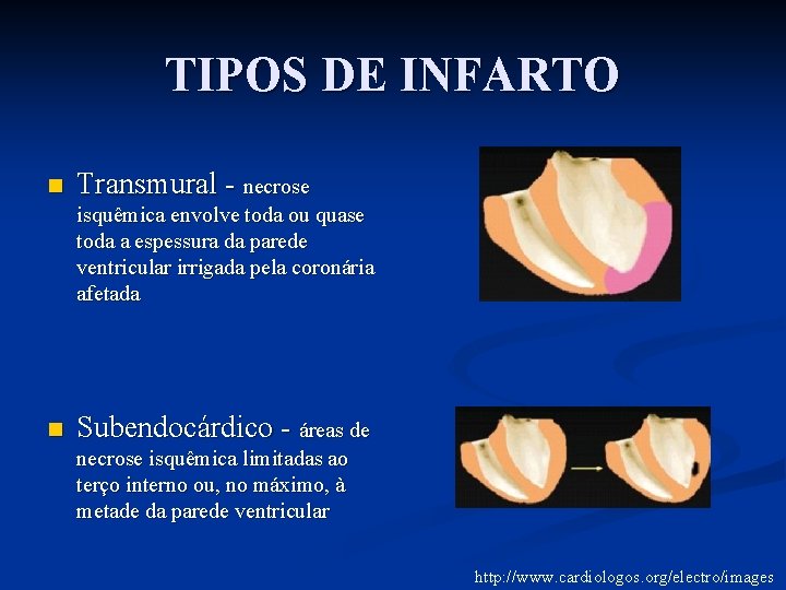 TIPOS DE INFARTO n Transmural - necrose isquêmica envolve toda ou quase toda a