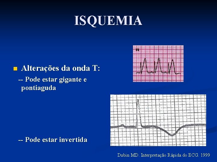ISQUEMIA n Alterações da onda T: -- Pode estar gigante e pontiaguda -- Pode