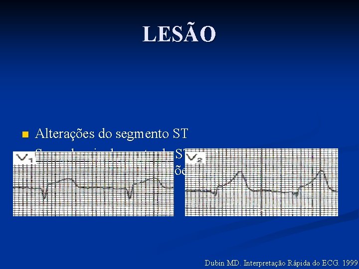 LESÃO n n Alterações do segmento ST Supradesnivelamento de ST (transmural) > 0, 1