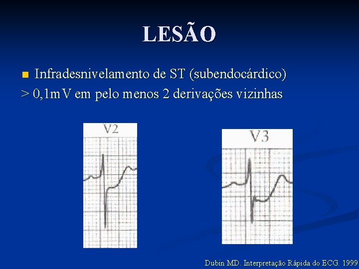 LESÃO Infradesnivelamento de ST (subendocárdico) > 0, 1 m. V em pelo menos 2
