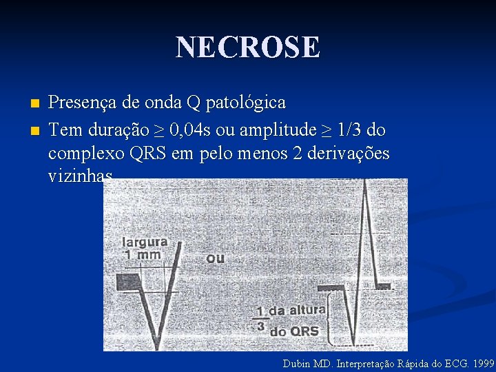 NECROSE n n Presença de onda Q patológica Tem duração ≥ 0, 04 s