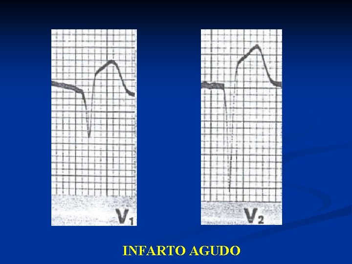 INFARTO AGUDO 