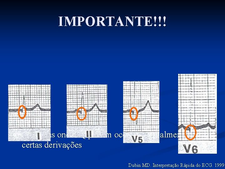 IMPORTANTE!!! n Pequenas ondas Q podem ocorrer normalmente em certas derivações Dubin MD. Interpretação