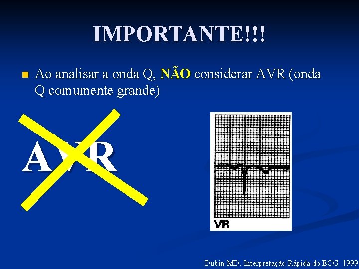 IMPORTANTE!!! n Ao analisar a onda Q, NÃO considerar AVR (onda Q comumente grande)