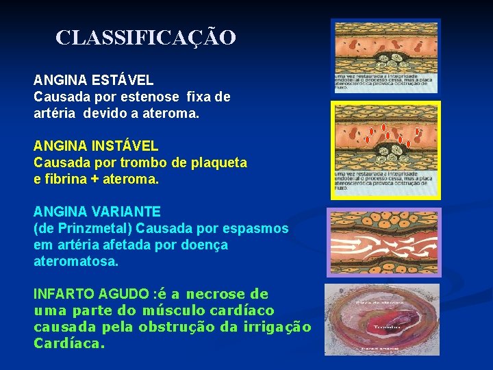 CLASSIFICAÇÃO ANGINA ESTÁVEL Causada por estenose fixa de artéria devido a ateroma. ANGINA INSTÁVEL