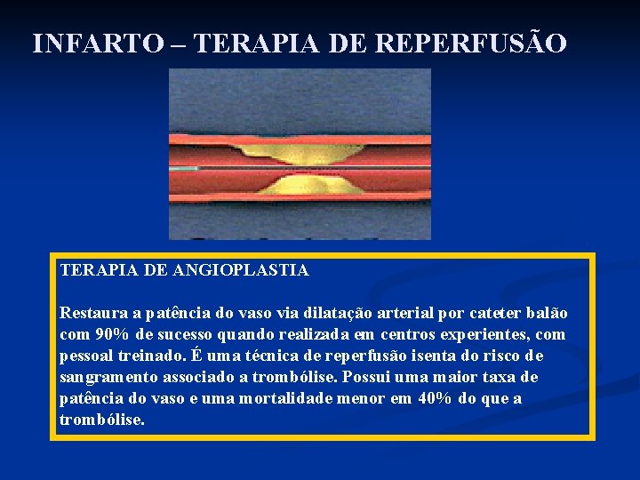 INFARTO – TERAPIA DE REPERFUSÃO TERAPIA DE ANGIOPLASTIA Restaura a patência do vaso via