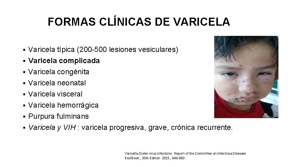 FORMAS CLÍNICAS DE VARICELA § § § § Varicela típica (200 -500 lesiones vesiculares)