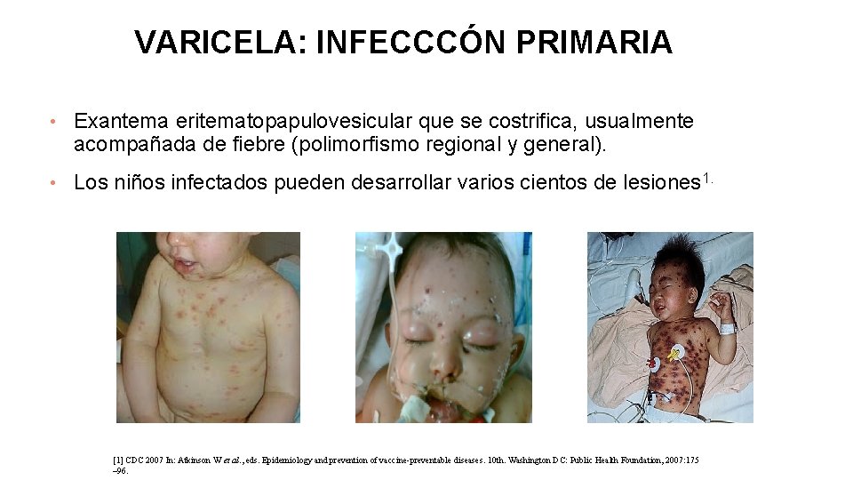 VARICELA: INFECCCÓN PRIMARIA • Exantema eritematopapulovesicular que se costrifica, usualmente acompañada de fiebre (polimorfismo