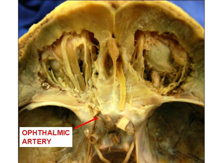 OPHTHALMIC ARTERY 