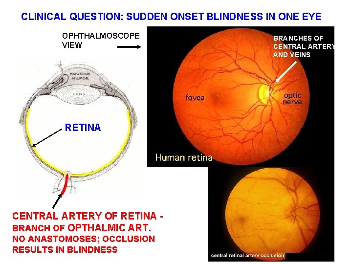 CLINICAL QUESTION: SUDDEN ONSET BLINDNESS IN ONE EYE OPHTHALMOSCOPE VIEW RETINA CENTRAL ARTERY OF