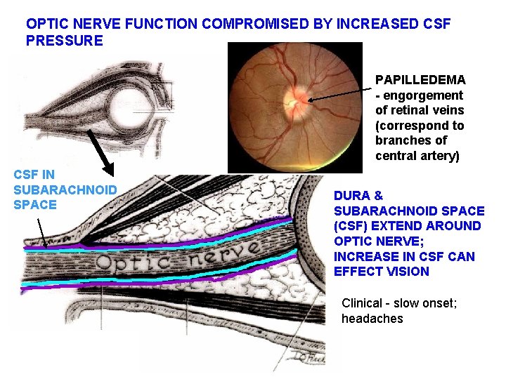 OPTIC NERVE FUNCTION COMPROMISED BY INCREASED CSF PRESSURE PAPILLEDEMA - engorgement of retinal veins