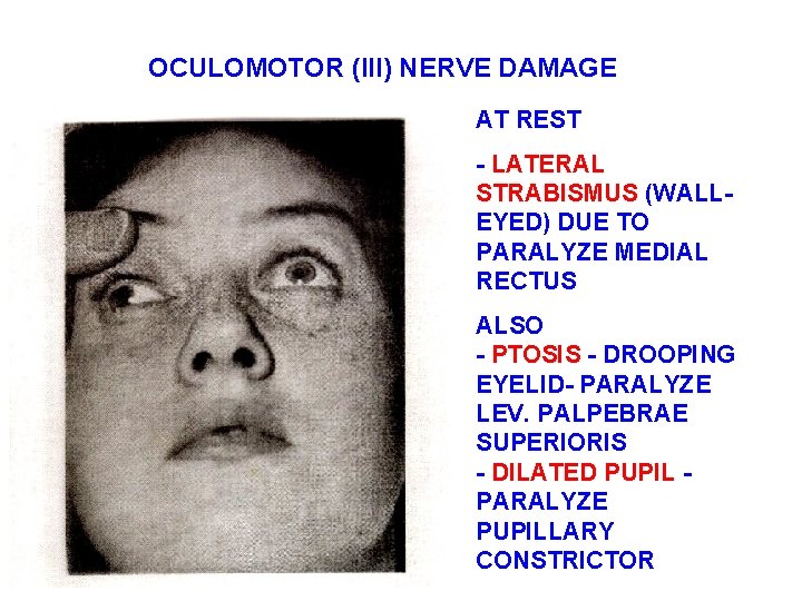 OCULOMOTOR (III) NERVE DAMAGE AT REST - LATERAL STRABISMUS (WALLEYED) DUE TO PARALYZE MEDIAL