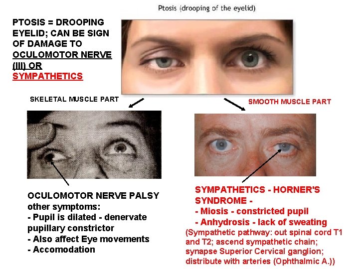 PTOSIS = DROOPING EYELID; CAN BE SIGN OF DAMAGE TO OCULOMOTOR NERVE (III) OR