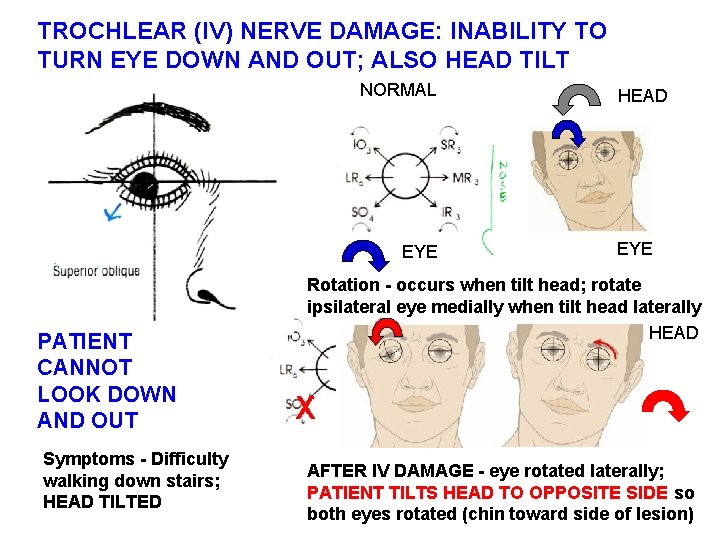 TROCHLEAR (IV) NERVE DAMAGE: INABILITY TO TURN EYE DOWN AND OUT; ALSO HEAD TILT