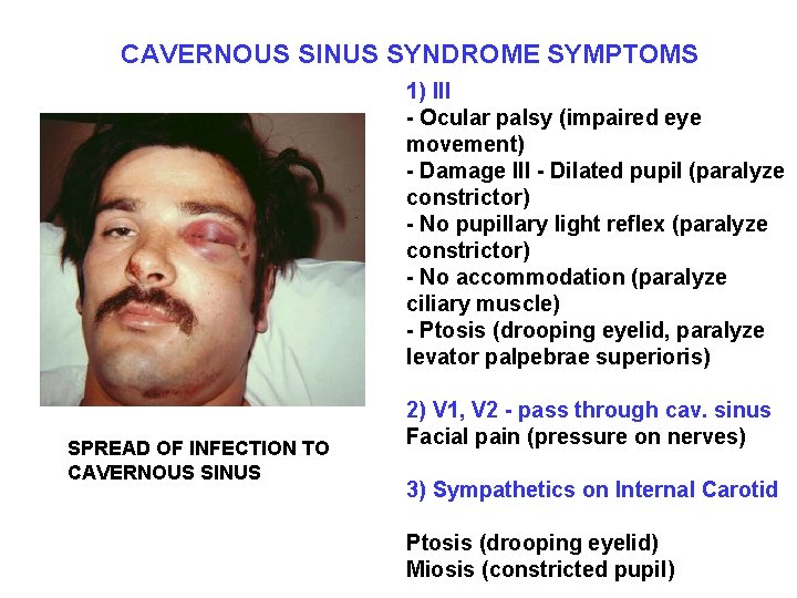 CAVERNOUS SINUS SYNDROME SYMPTOMS 1) III - Ocular palsy (impaired eye movement) - Damage