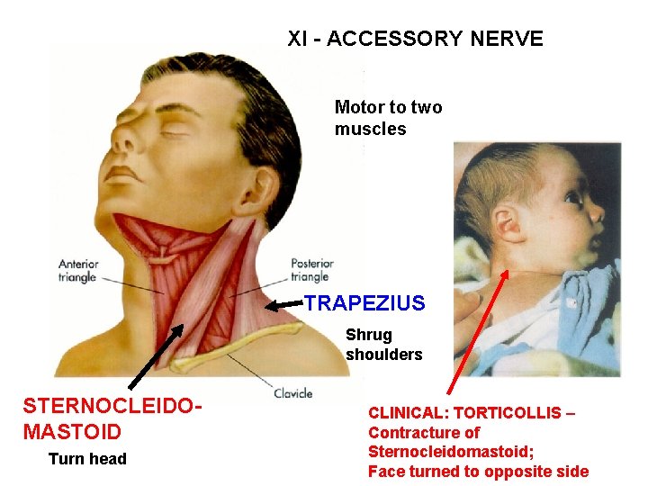 XI - ACCESSORY NERVE Motor to two muscles TRAPEZIUS Shrug shoulders STERNOCLEIDOMASTOID Turn head