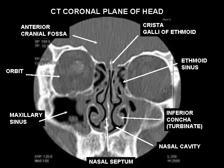 CT CORONAL PLANE OF HEAD CRISTA GALLI OF ETHMOID ANTERIOR CRANIAL FOSSA ETHMOID SINUS