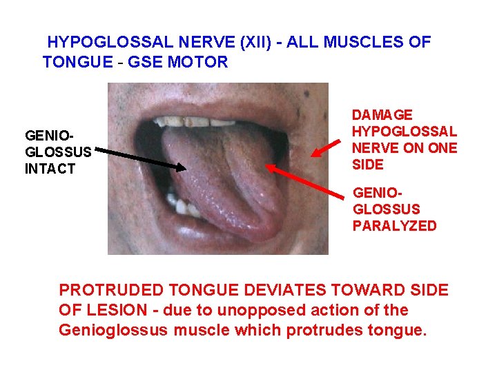 HYPOGLOSSAL NERVE (XII) - ALL MUSCLES OF TONGUE - GSE MOTOR GENIOGLOSSUS INTACT DAMAGE