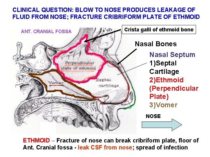 CLINICAL QUESTION: BLOW TO NOSE PRODUCES LEAKAGE OF FLUID FROM NOSE; FRACTURE CRIBRIFORM PLATE