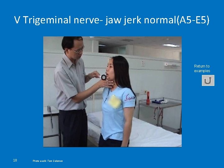V Trigeminal nerve- jaw jerk normal(A 5 -E 5) Return to examples 18 Photo