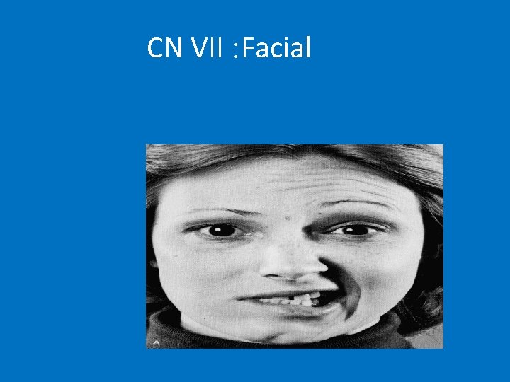CN VII : Facial 