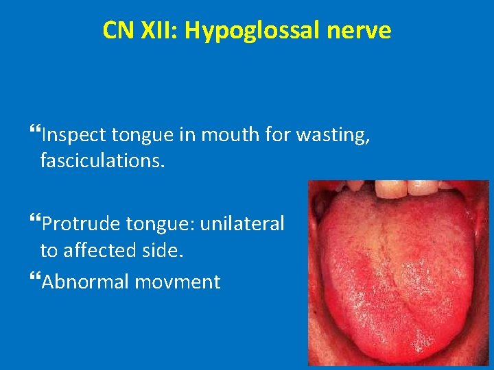 CN XII: Hypoglossal nerve Inspect tongue in mouth for wasting, fasciculations. Protrude tongue: unilateral