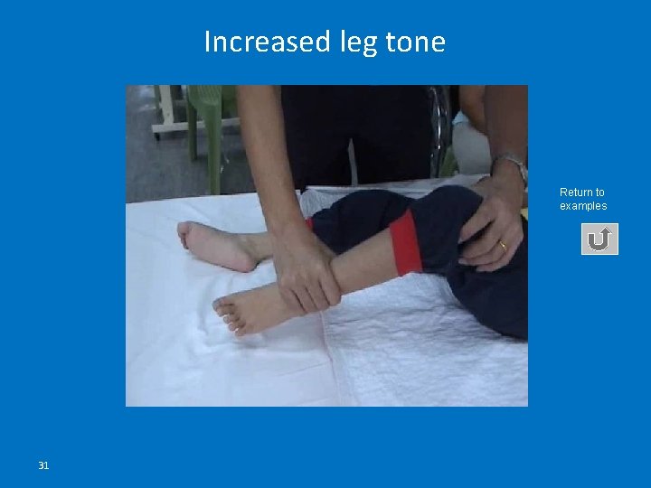 Increased leg tone Return to examples 31 