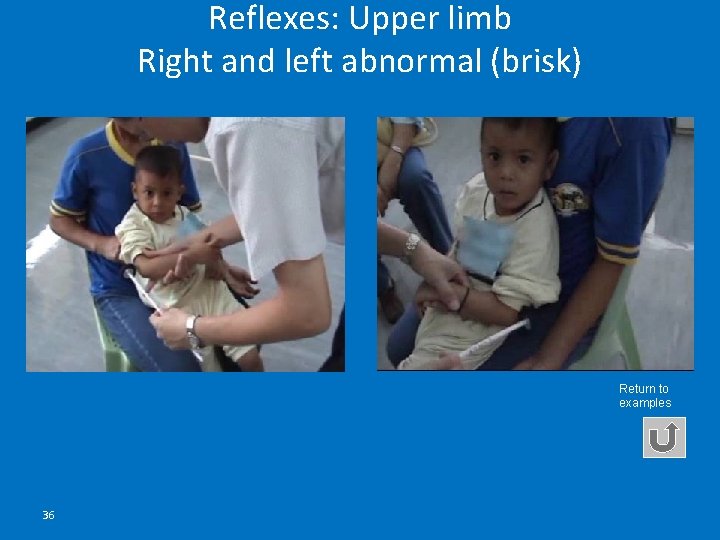 Reflexes: Upper limb Right and left abnormal (brisk) Return to examples 36 