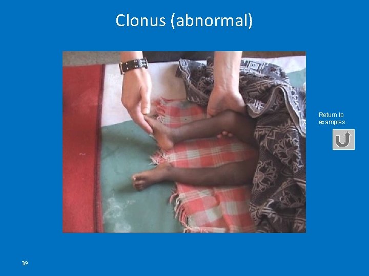 Clonus (abnormal) Return to examples 39 