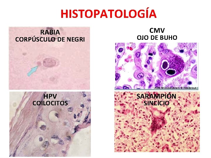 HISTOPATOLOGÍA RABIA CMV CORPÚSCULO DE NEGRI OJO DE BUHO HPV SARAMPIÓN COILOCITOS SINCICIO 