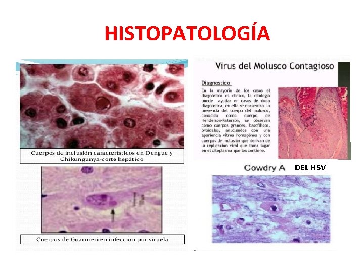 HISTOPATOLOGÍA DEL HSV 