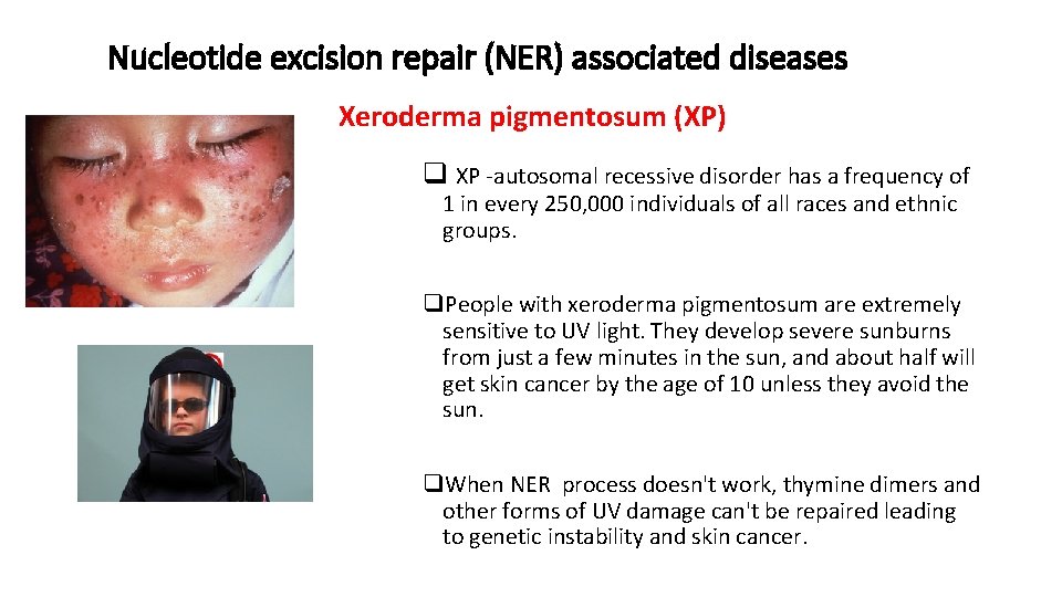 Nucleotide excision repair (NER) associated diseases Xeroderma pigmentosum (XP) q XP -autosomal recessive disorder
