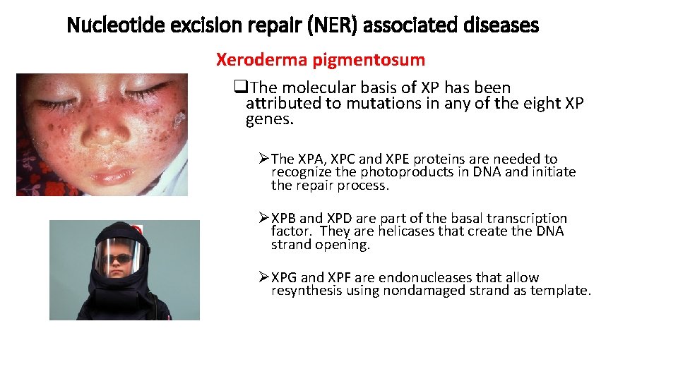 Nucleotide excision repair (NER) associated diseases Xeroderma pigmentosum q. The molecular basis of XP