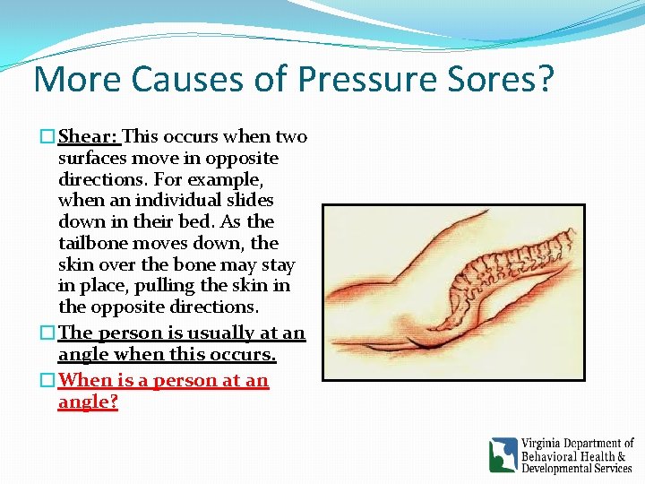 More Causes of Pressure Sores? �Shear: This occurs when two surfaces move in opposite More Causes of Pressure Sores? �Shear: This occurs when two surfaces move in opposite