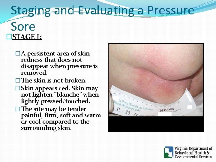 Staging and Evaluating a Pressure Sore �STAGE I: �A persistent area of skin redness Staging and Evaluating a Pressure Sore �STAGE I: �A persistent area of skin redness